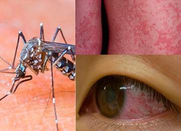 Imagen para la gallería Mosco y síntomas del zika