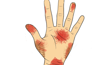 Imagen de una mano con padecimiento con afecciones en la piel.