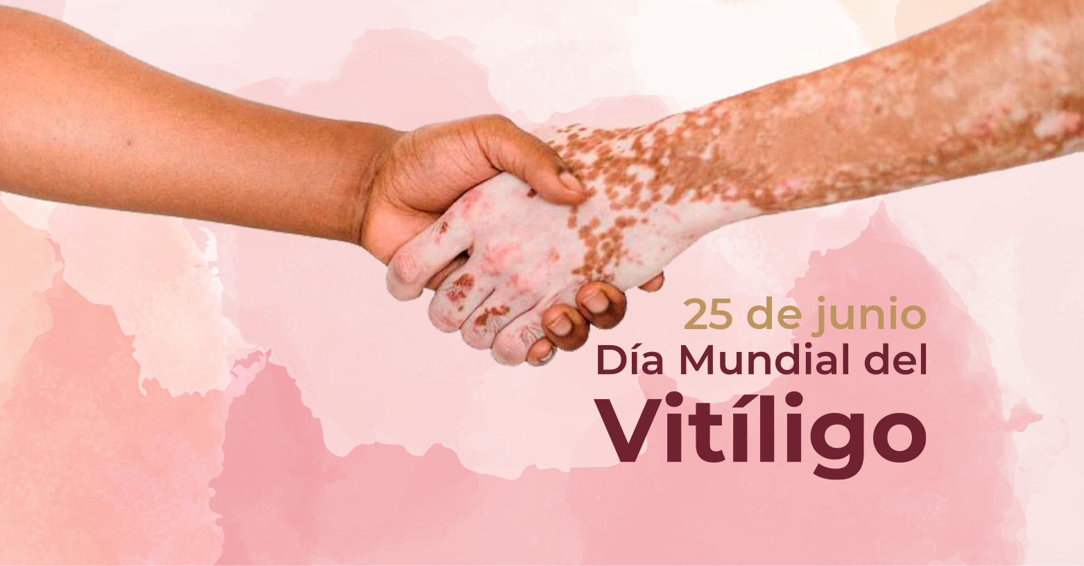 Día Mundial del Vitíligo | 25 de junio