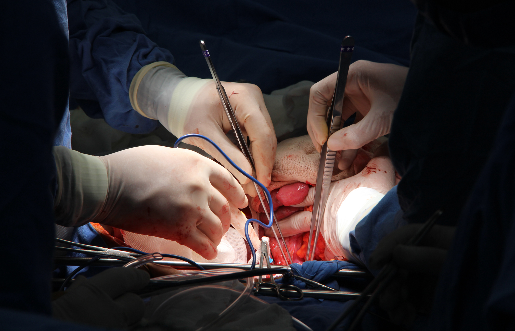 Manos de médicos en cirugía para la procuración de órganos de un donador de 12 años.