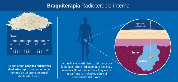 /cms/uploads/image/file/867961/Braquiterapia-radioterapia_interna.png