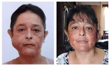 Médicos del IMSS operaron a una derechohabiente en el Hospital General de Zona No.7 en Coahuila, quien presentaba un tumor que le deformaba su rostro.