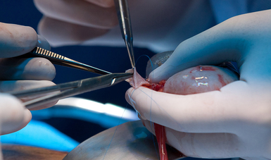 Foto de un riñón en proceso de trasplante.